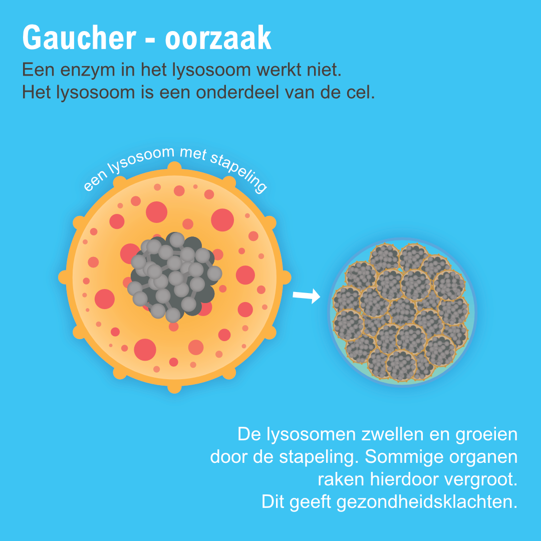 Ziekte van Gaucher type 3 infographic afbeelding 0
